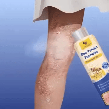 Spray de Psoriazis cu Venin de Albine